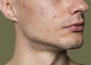 Jerawat Karena Stress : Segera Atasi Dengan Cara Ini